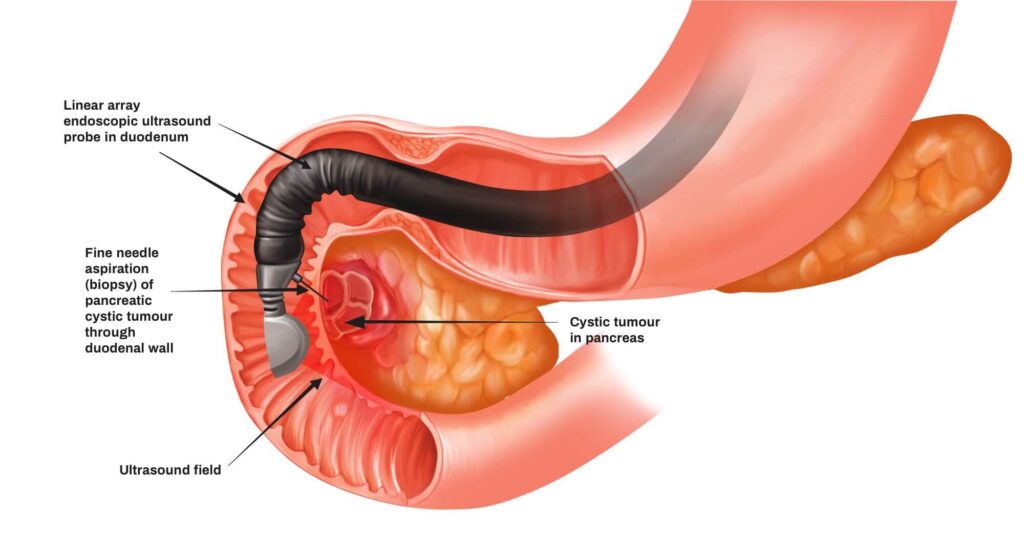 Endoscopy Procedure