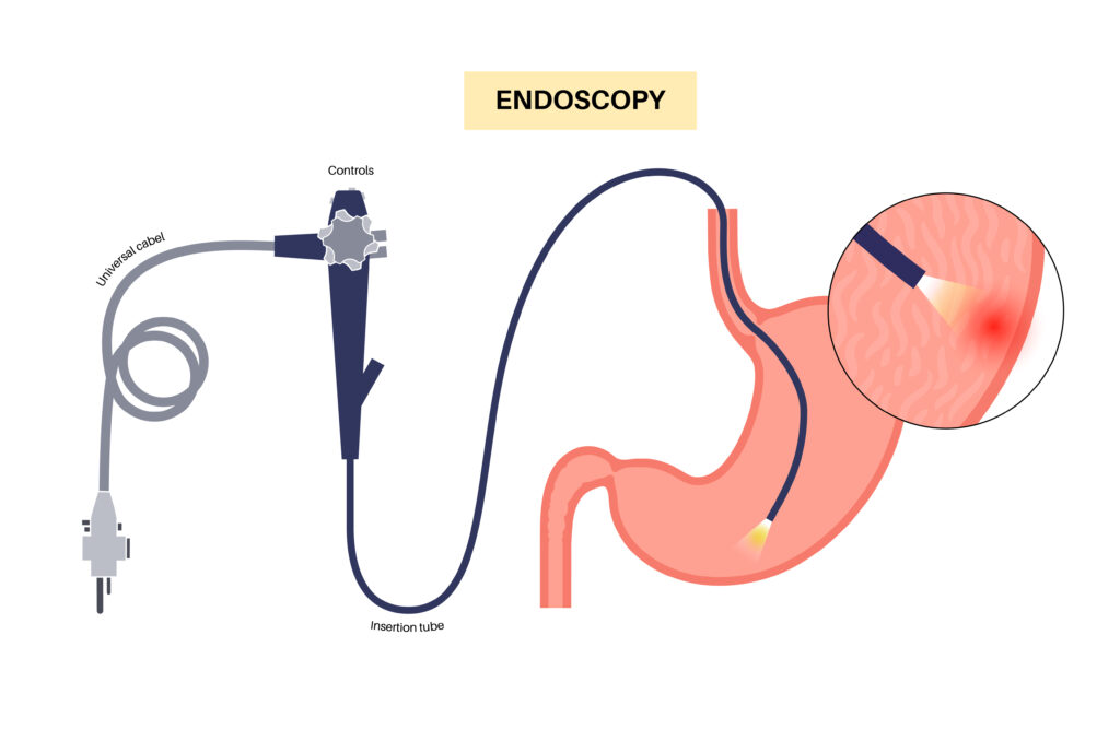 Endoscopy Procedure