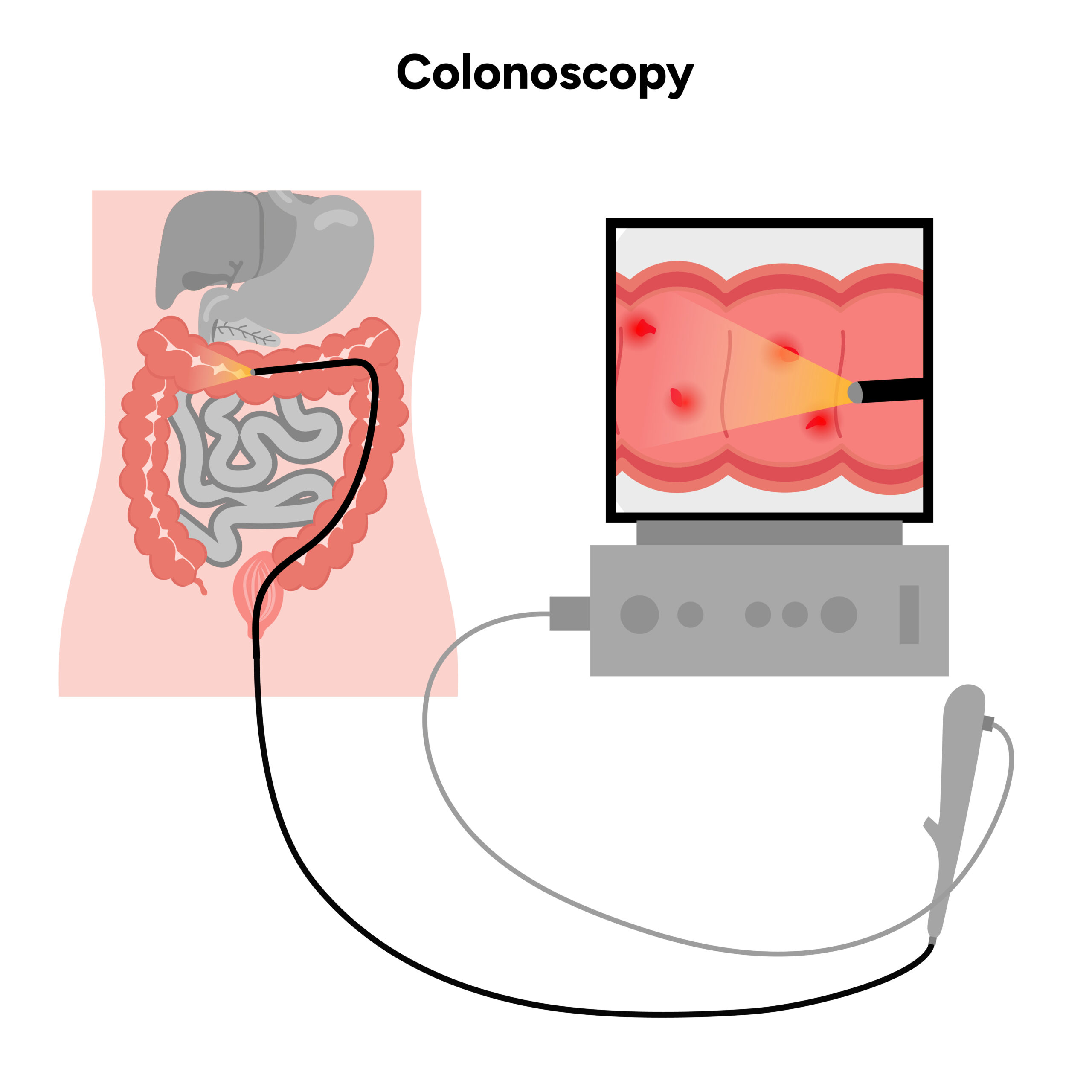 Colonoscopy