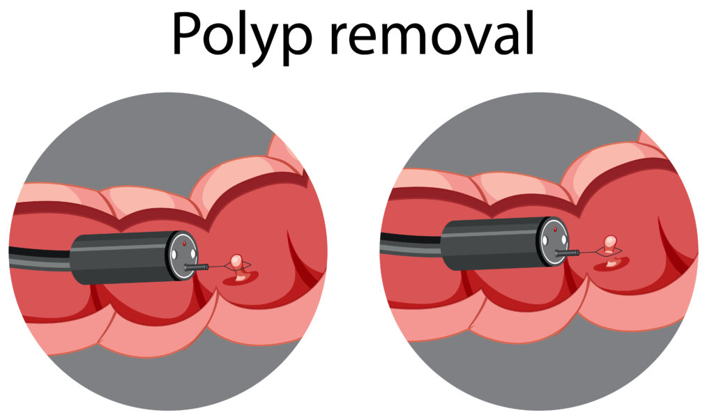 Endoscopy Procedures