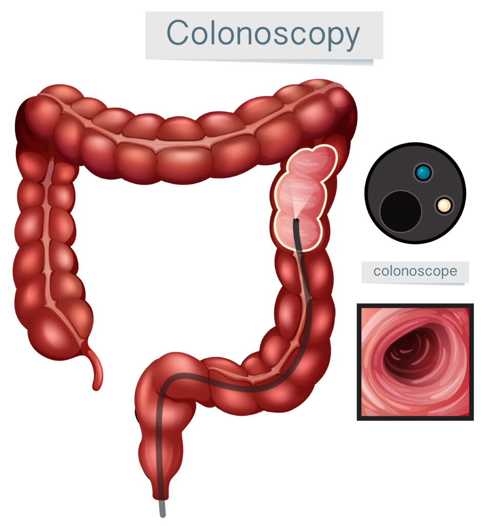 Colonoscopy Procedure