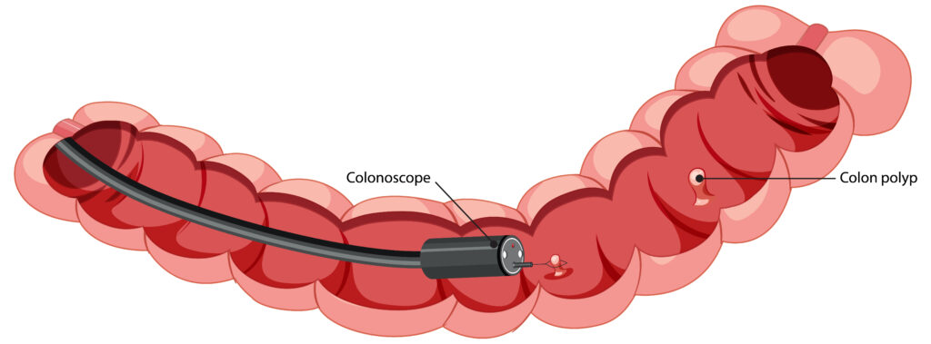 Colonoscopy Procedure in Lahore – Complete Procedure