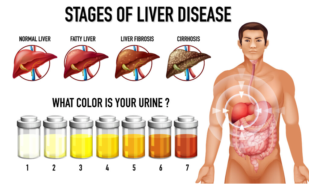 Liver Disease