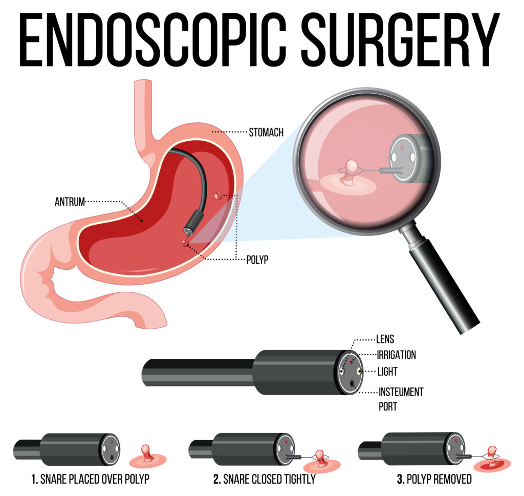 endoscopy