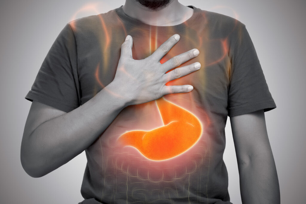 When Is Heartburn More Than Acid Reflux? A Stomach Specialist Explains GERD and Barrett’s Esophagus