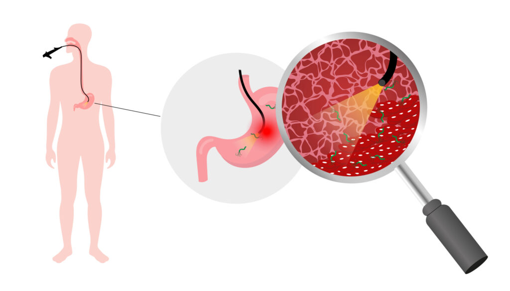 Gastroscopy