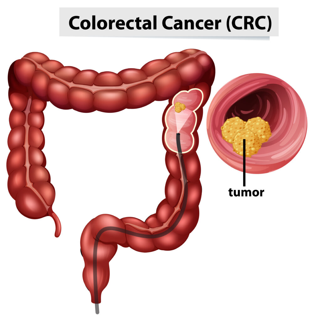 Colonoscopy