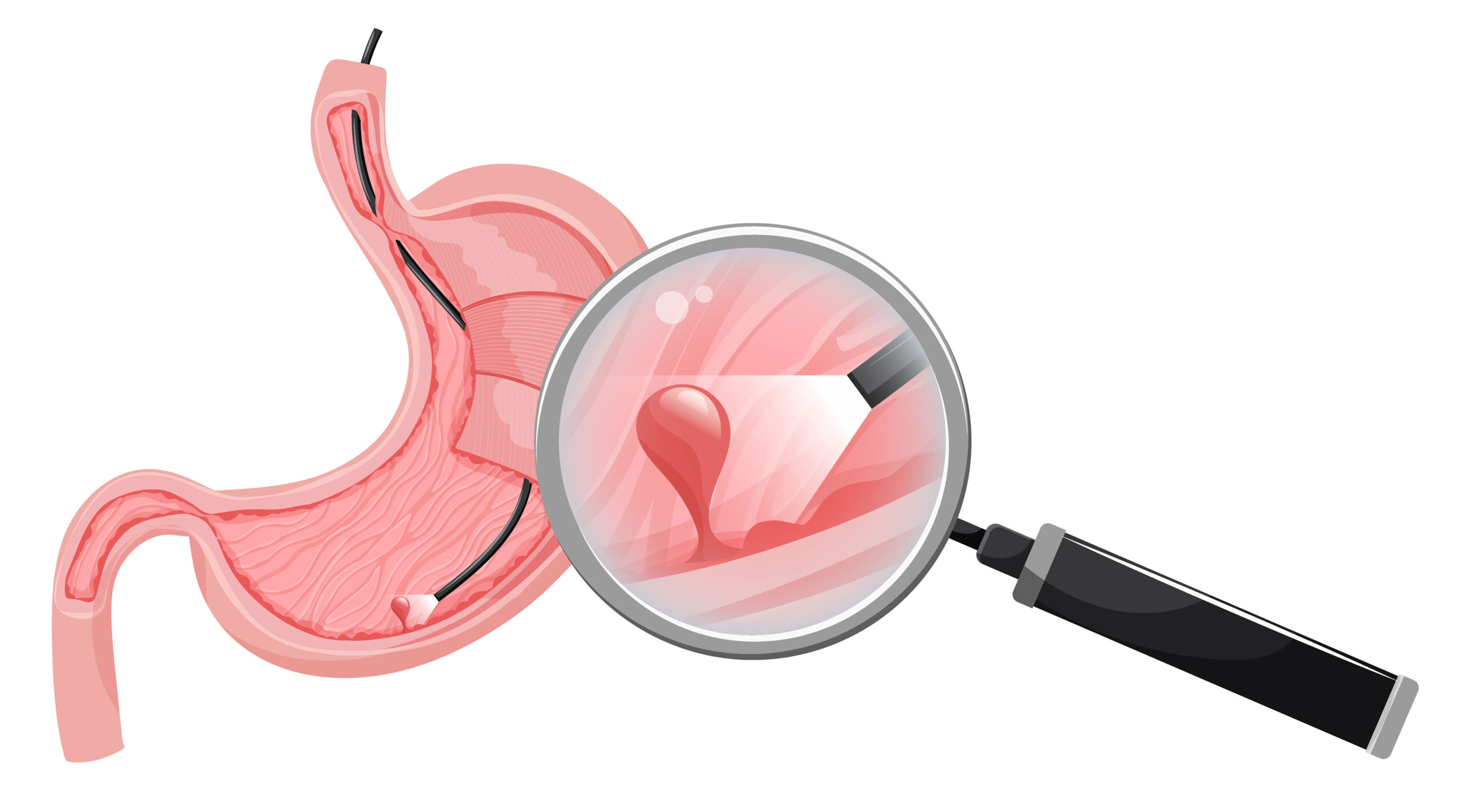 Why an Upper GI Endoscopy Is the Gold Standard for Diagnosing Celiac Disease and Food Intolerances