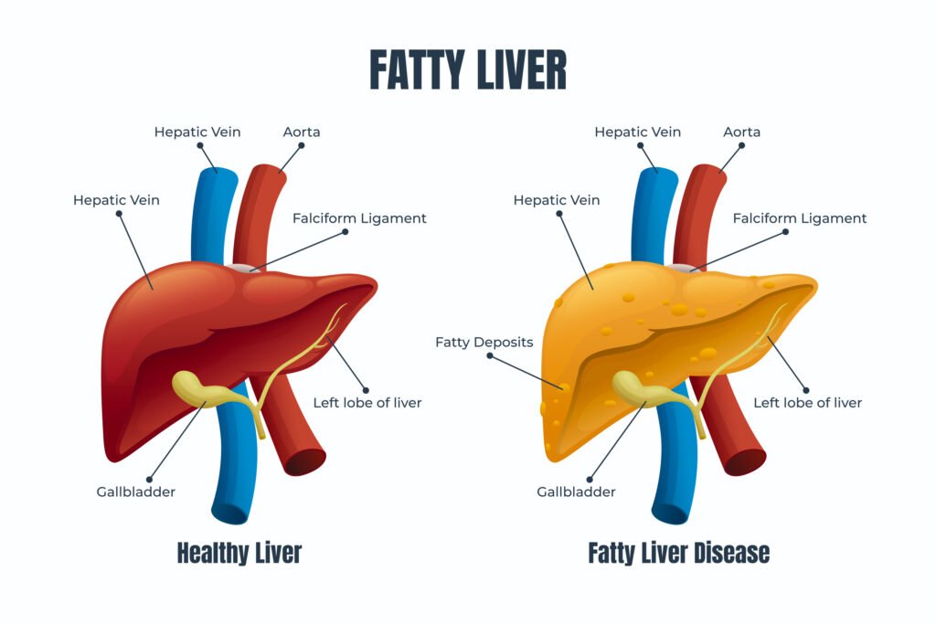 Why Diabetes and High Blood Pressure Increase Your Risk of Fatty Liver Disease 